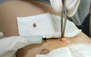 az emberi papillomavírus műtéti kezelése