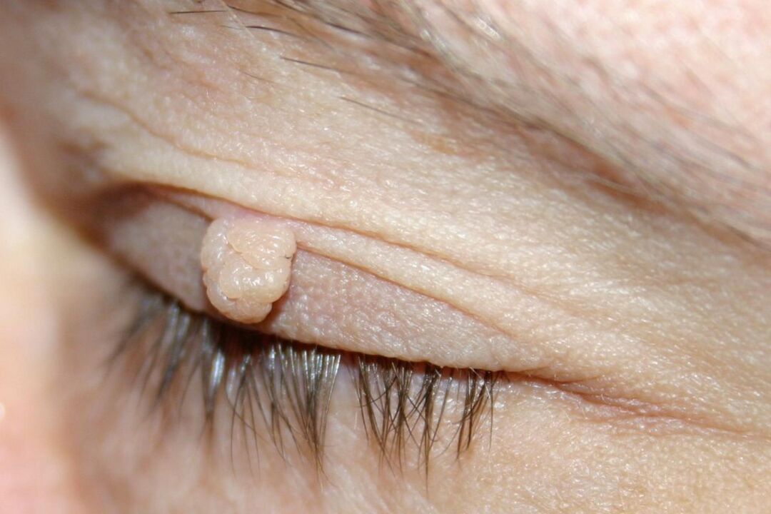 papilloma tünetei a szemhéjon